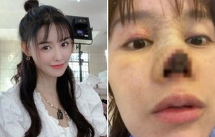 中国女優の高溜(ガオ・リュウ)、鼻整 形後に”壊死”…写真公開し韓国でも話題に 
